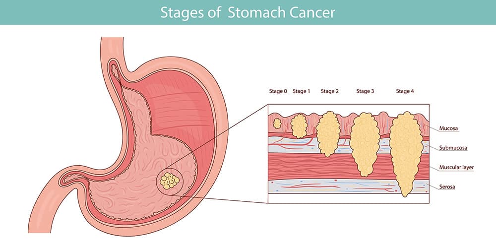 Illustration of stomach cancer stages