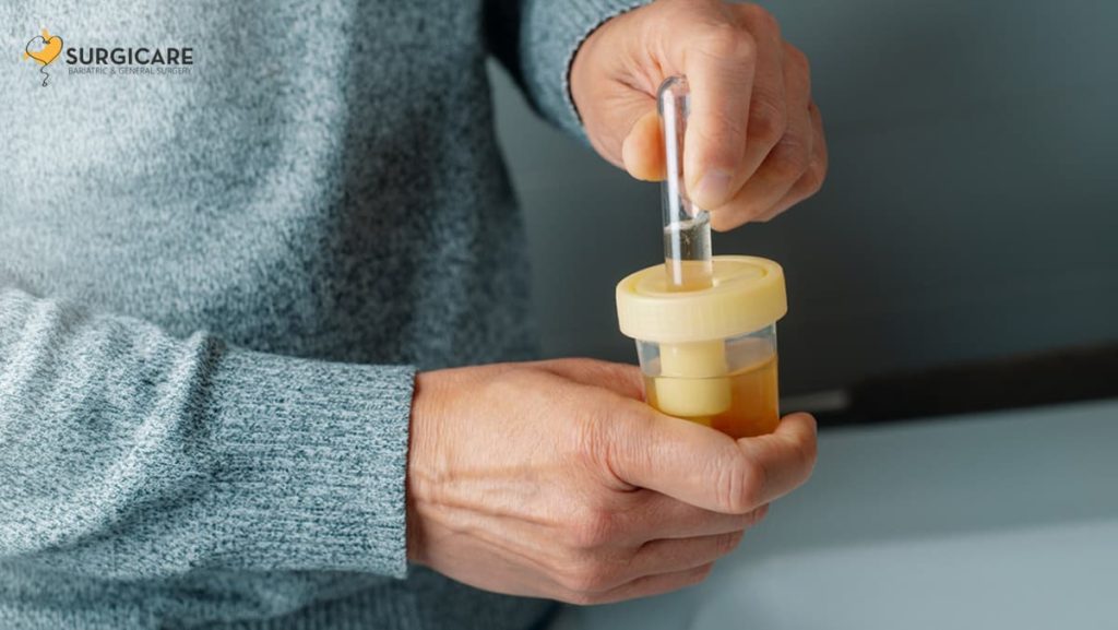Is Tea-Coloured Urine a Sign of Gallstones? Here’s What to Know