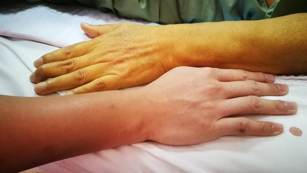Image of Jaundice vs normal skin