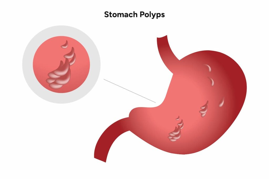 Stomach Polyps