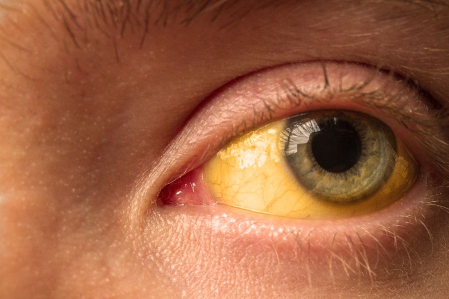 Symptoms of Jaundice Yellow Eye